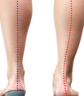 How orthotics help alignment - Rose City Wellness